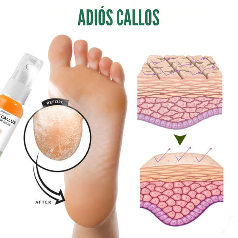 Foot Callus™ - SPRAY ANTICALLOS